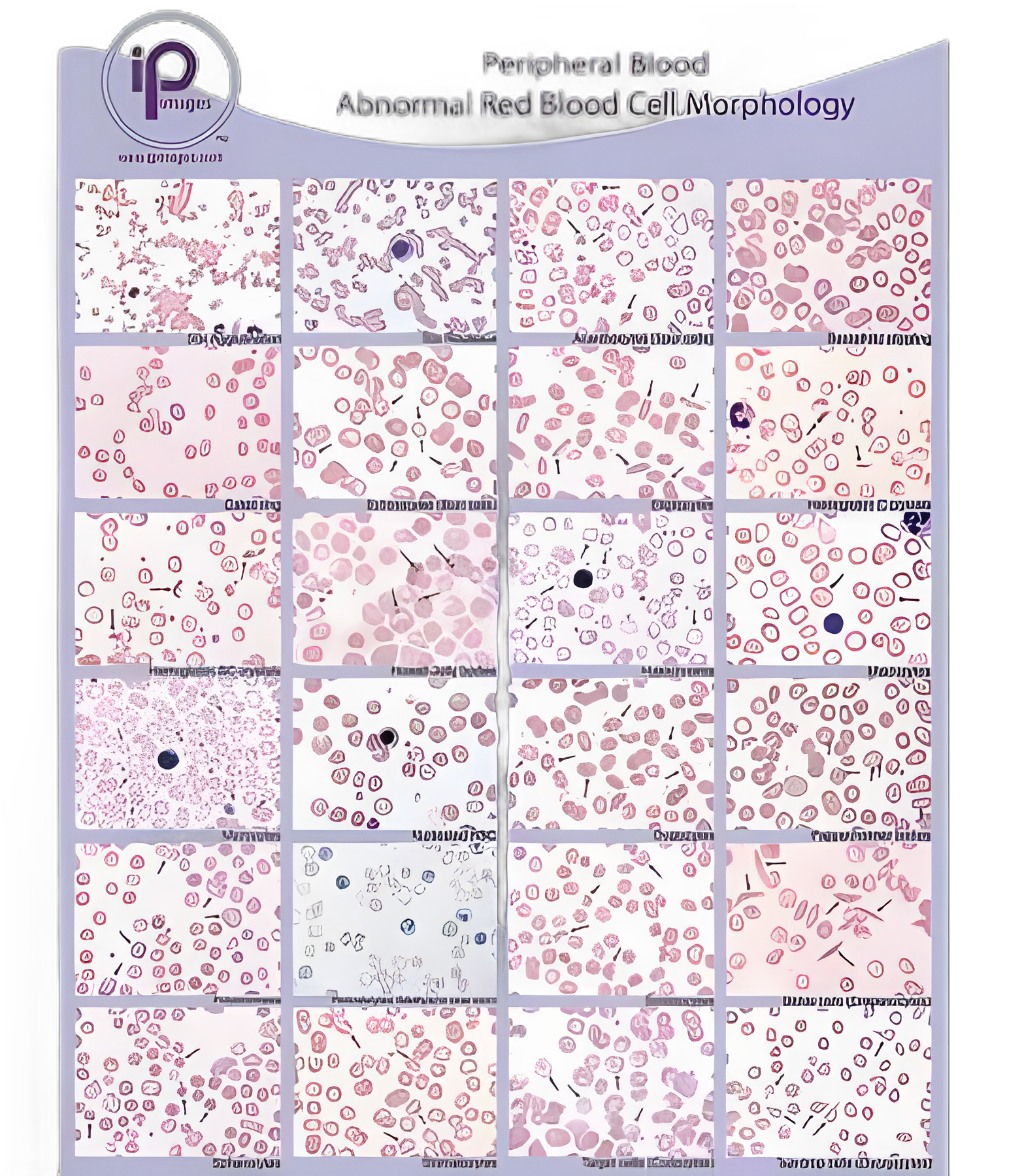 Anatomical Chart Blood Abnormal Red Blood Cell (RBC) Morphology ...