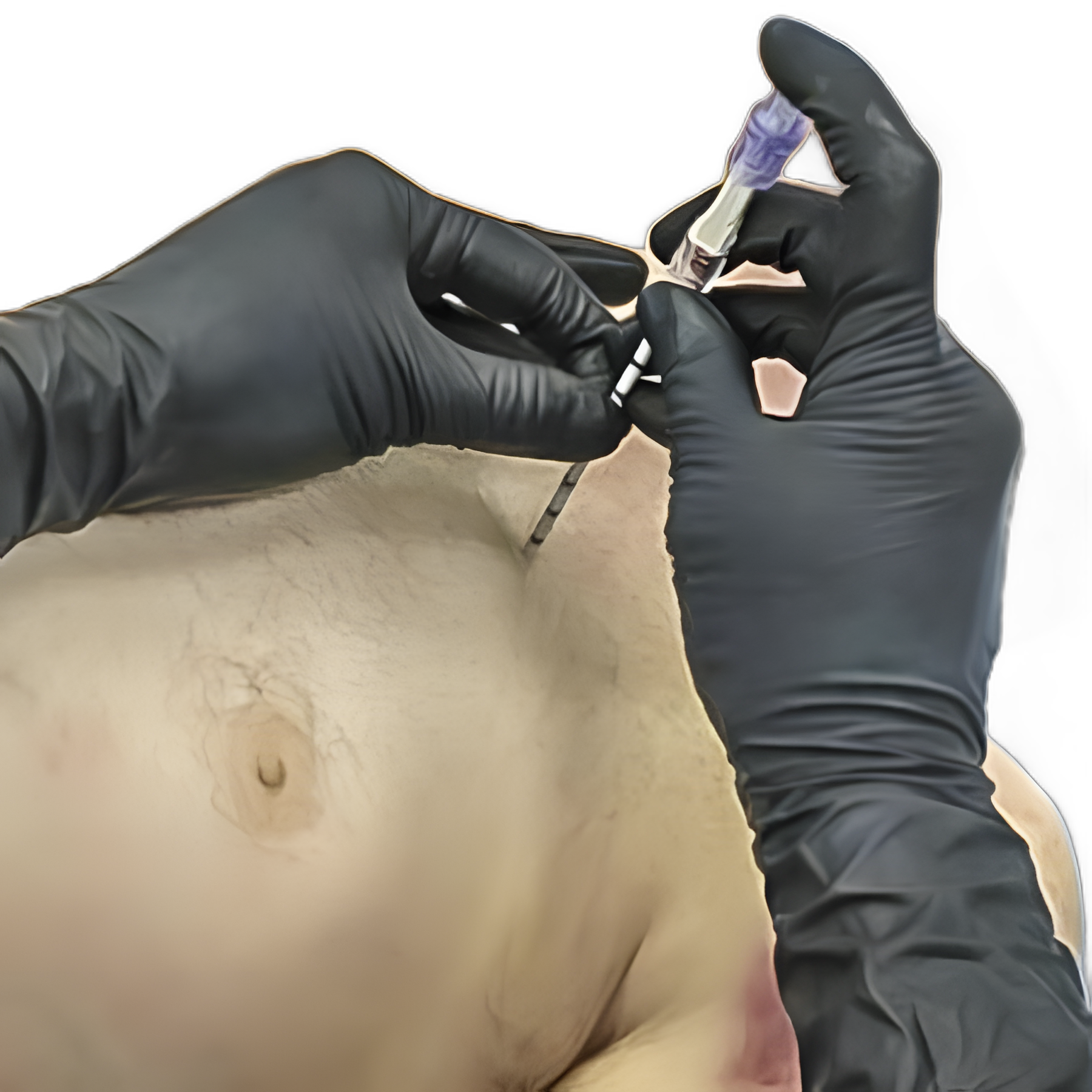 North American Rescue Pneumothorax Needle/Catheter for Tension Pneumothorax Treatment